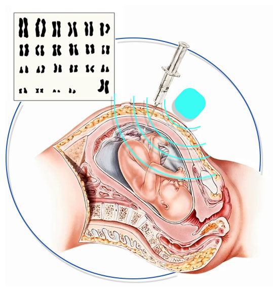 AMNIOCENTESIS (AFT) AMNIOCENTESIS (AFT)