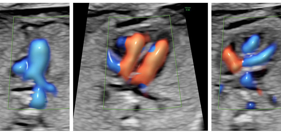 13.haftada renkli Doppler ile bebeğin kalbi ve ana atardamarları 13.haftada renkli Doppler ile bebeğin kalbi ve ana atardamarları