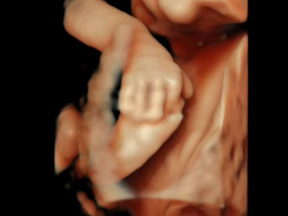 Ayağını yakalamış bebek (27.haftada transabdominal 3D US ile)