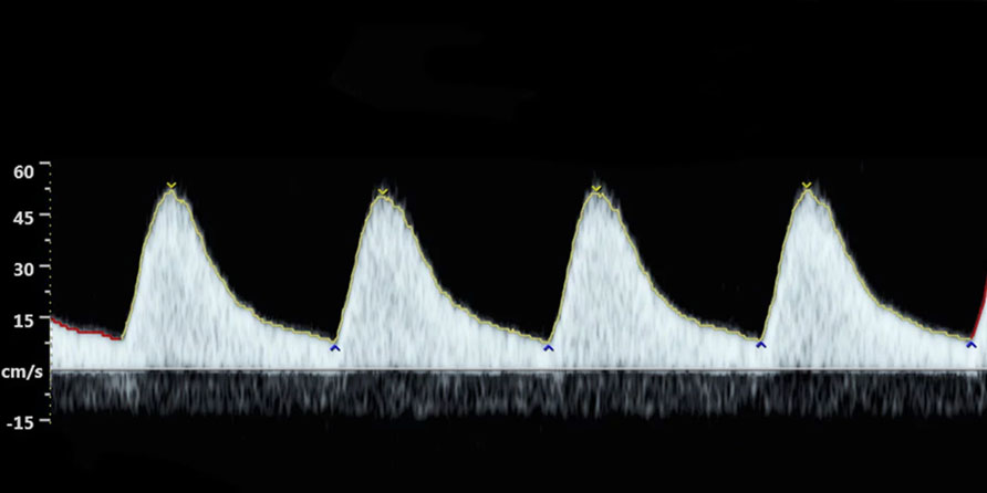 Doppler Ultrason Tekniği Nedir?