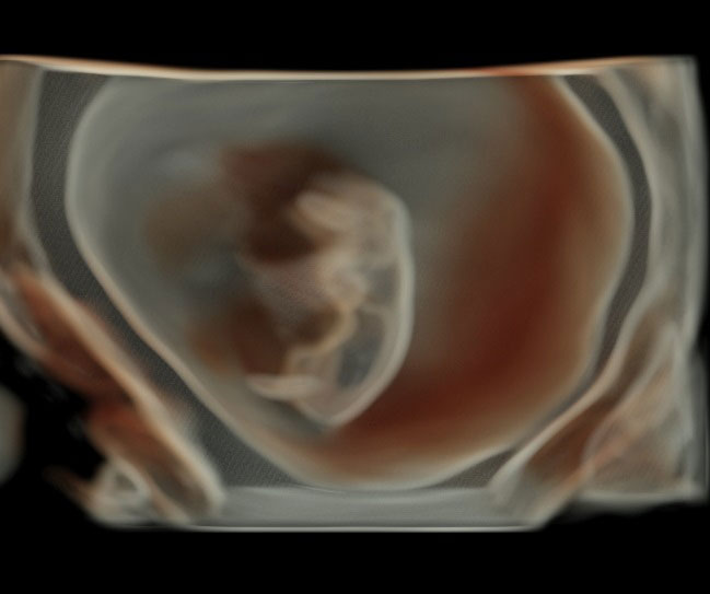 Transabdominal 3D ile 8 haftalık canlılık muayenesi (bebek yaklaşık 1,5 cm) Transabdominal 3D ile 8 haftalık canlılık muayenesi (bebek yaklaşık 1,5 cm)